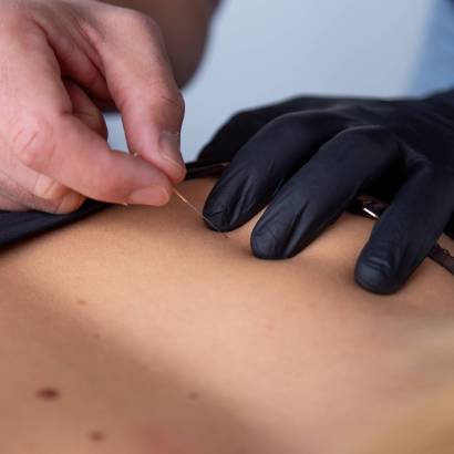Dry Needling